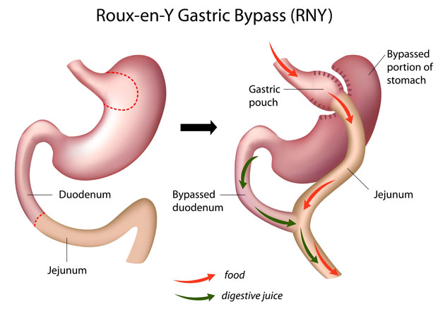 Gastric Bypass