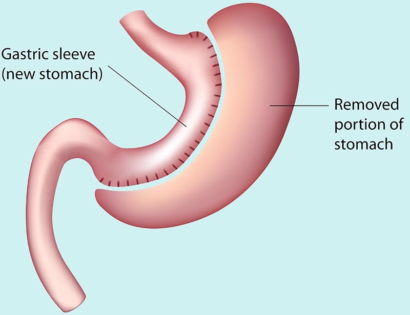 Sleeve Gastrectomy
